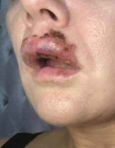 Preenchimento labial